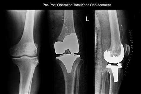 xray left knee and show pre-post operation total knee replacement - New ...