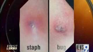 Bug Bite Vs Staph Infection