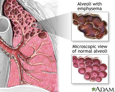 Chronic obstructive pulmonary disease (COPD): MedlinePlus Medical ...