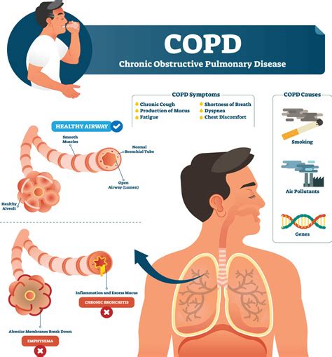 Chronic Obstructive Pulmonary Disease Copd Treatment London - PELAJARAN