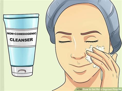 3 Ways to Get Rid of Ingrown Pimples - wikiHow