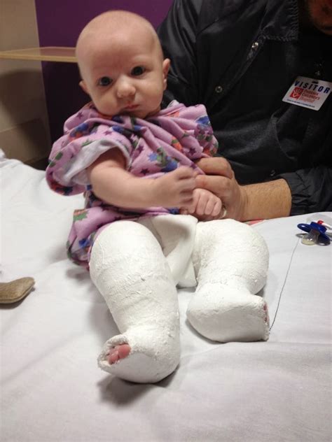 The Clubfoot Chronicles: Tenotomy