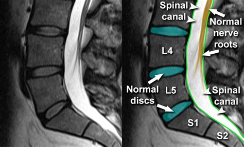 Mri Lumbar Spine Nerve Roots