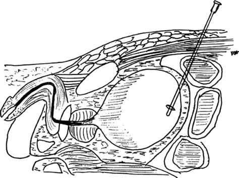 Percutaneous Suprapubic Cystostomy | Anesthesia Key