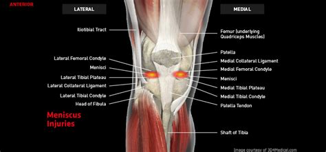 Knee_MeniscusInjuries_large - Thermoskin - supports and braces for ...