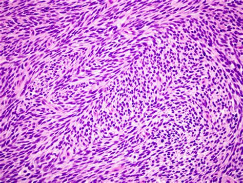 Synovial Sarcoma - Pathology - Orthobullets