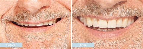 Dentures Before And After Pictures - KeanaSerina