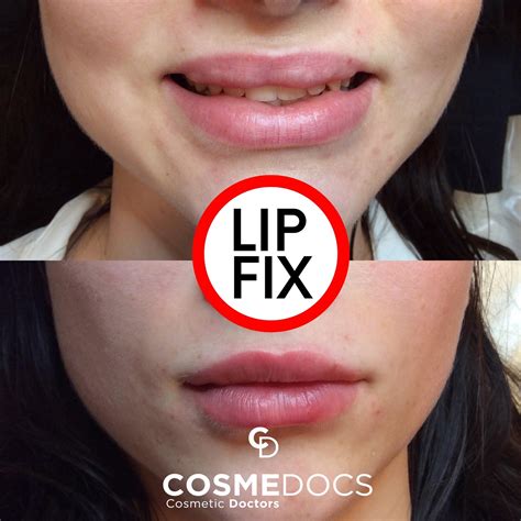 Lip Fillers Gone Wrong Or A Dream Gone Sour? You Decide!