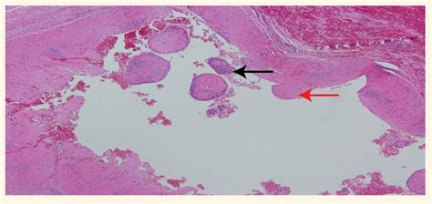 Synovial Cyst Histology