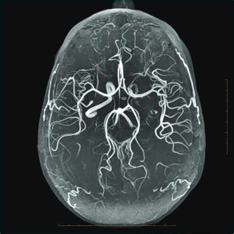 MR Angiography (MRA) - Insight Medical Imaging