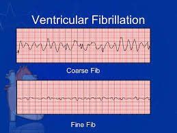 Coarse Ventricular Tachycardia