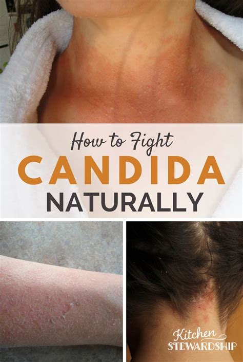 Pin on Candida/skin