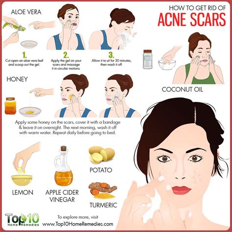 How to Get Rid of Acne Scars | Top 10 Home Remedies