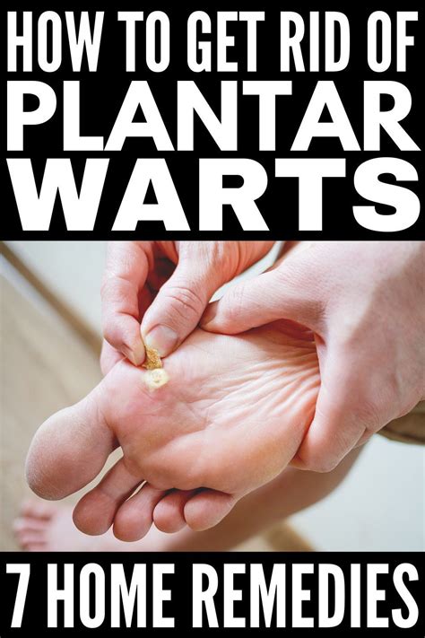 Plantar warts – Artofit