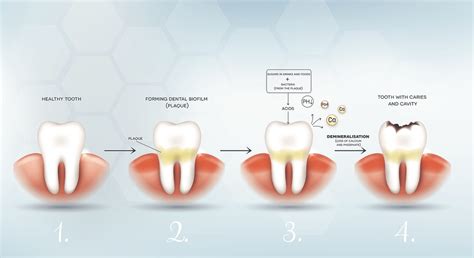 How To Remove Tartar From Toddler Teeth - HOWTOREMVO