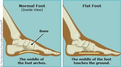 Flat Feet (for Parents) | Nemours KidsHealth