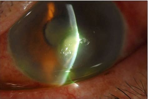 Corneal ulceration with impending corneal perforation was seen by slit ...