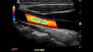 Carotid Artery: Carotid Artery Doppler