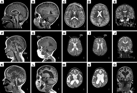 MRI scan images of patient NM720. Brain MRI in a normal 3-year-old...