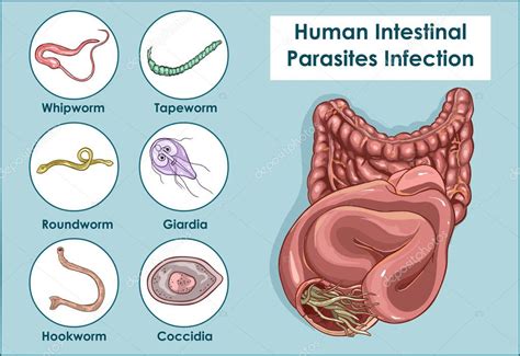 Ilustración vectorial de parásitos intestinales humanos Vector de Stock ...