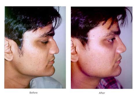 HUMP NOSE 21 years old with hump nose and a poorly defined and ...