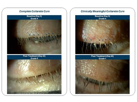 Demodex Eyelash Mites