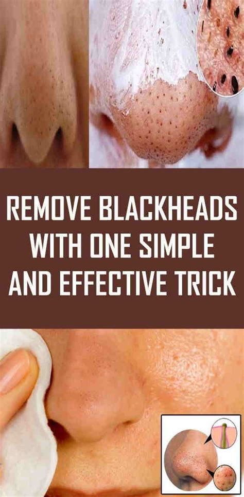 Remove Blackheads With One Simple And Effective Trick - Fitness And ...