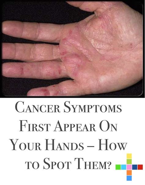 39 best Cancer images on Pinterest | Cancer treatment, Health and ...