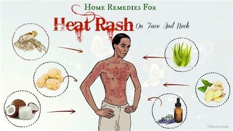 Heat Rash On Buttocks Treatment