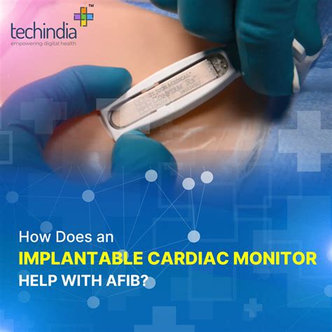 How Does an Implantable Cardiac Monitor Help with aFib? | Cardiac Event ...