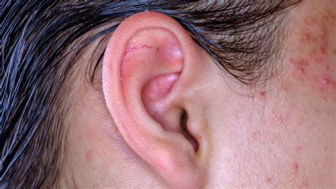 How To Pop A Pimple Deep In Your Ear at Paul Makris blog