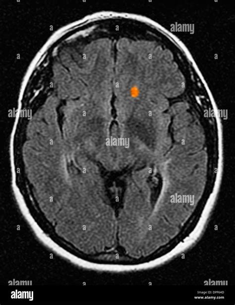 Multiple sclerosis mri hi-res stock photography and images - Alamy