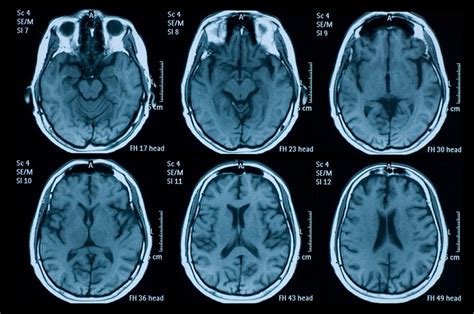 Brain MRI and EEG Clues to COVID-19-Related Encephalopathy ...