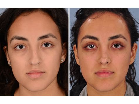 Rhinoplasty (Nose Job) — Dallas Plastic Surgeon specializing in ...