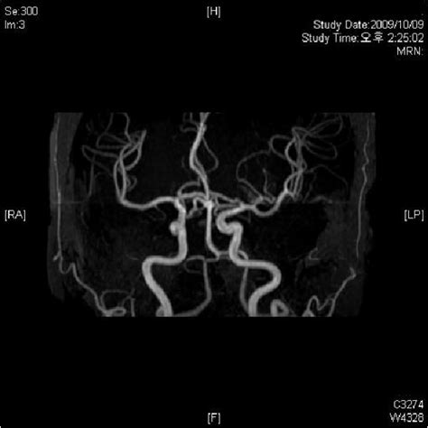 Normal study of MRA angiography. Abbreviation: MRA, Magnetic resonance ...