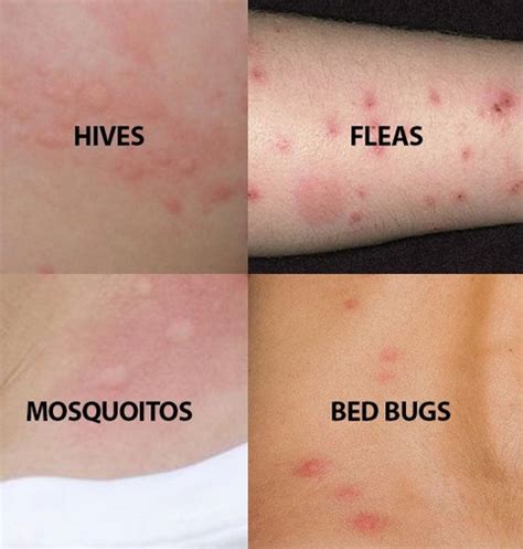 Bed Bug Bites How To Treat | Bed Bug Bites Treatment