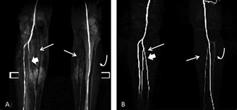 Noncontrast MR angiography (NC-MRA) and contrast-enhanced MR ...