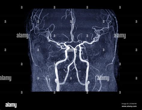 MRA Brain or Magnetic resonance angiography ( MRA ) of cerebral artery ...