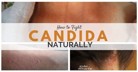 How to Fight Candida Naturally