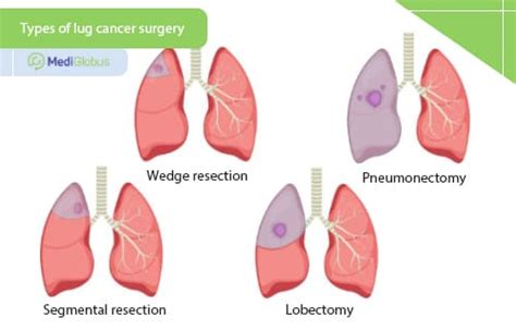 Surgery for lung cancer | MedicGlobus