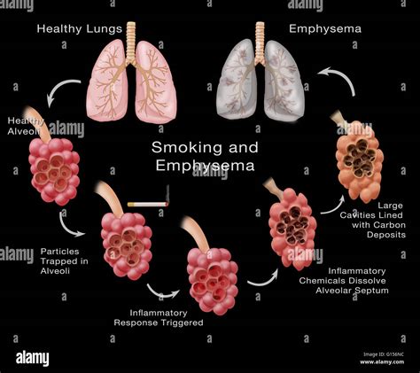 Stages of lung damage of a smoker leading to emphysema. The ...