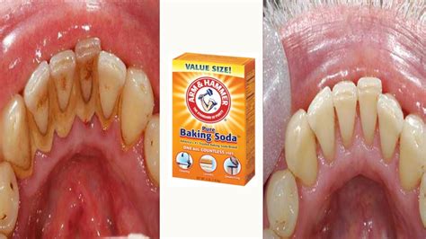 How To Remove Tartar From Teeth Yourself - TeethWalls