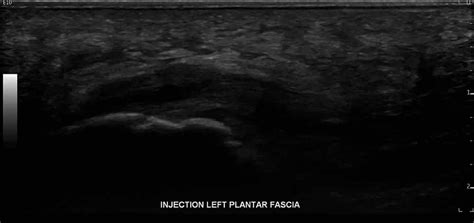 Plantar Fascia Tear Ultrasound