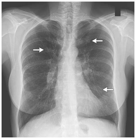 Normal Chest X Ray Vs Bronchitis