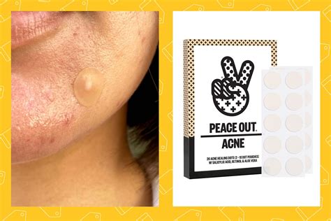 11 Best Pimple Patches 2023, 52% OFF | www.elevate.in