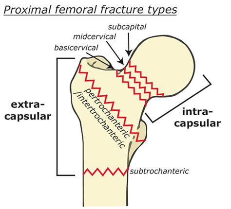 Femoral neck fracture causes, types, symptoms, diagnosis, treatment ...