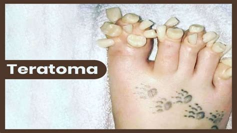 Teratoma: Types, Symptoms, Causes, Diagnosis And Treatment - Boldsky.com