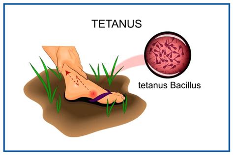 Tetanus: Causes, Symptoms & Treatment