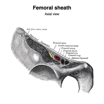 Femoral Canal Hernia