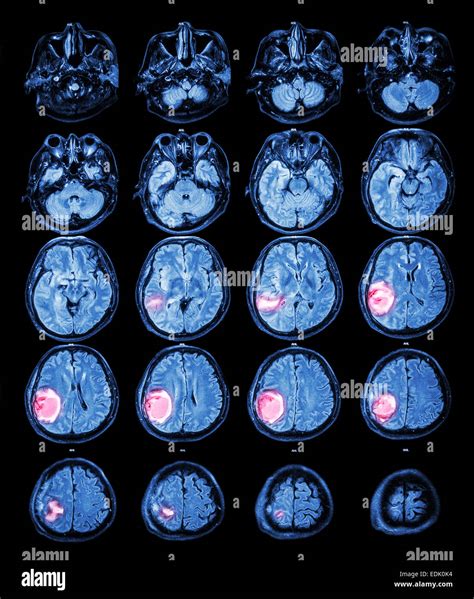 Mri brain tumor hi-res stock photography and images - Alamy